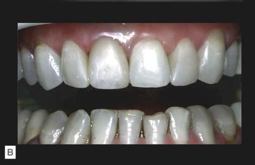 Discromie de etiologie endodontică la nivelul incisivului central superior drept, asociată cu discromii generate de pigmentarea restaurărilor compozite vechi şi