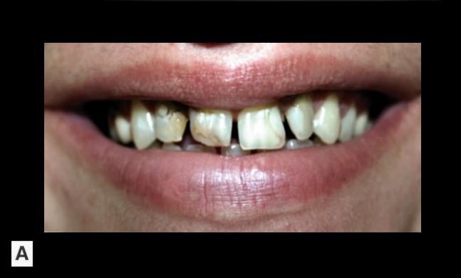 106 FIZIOLOGIA ŞI PATOLOGIA CROMATICII DENTARE tenţa unor manifestări de tip distrofic, distrucţii dentare extinse, etc.