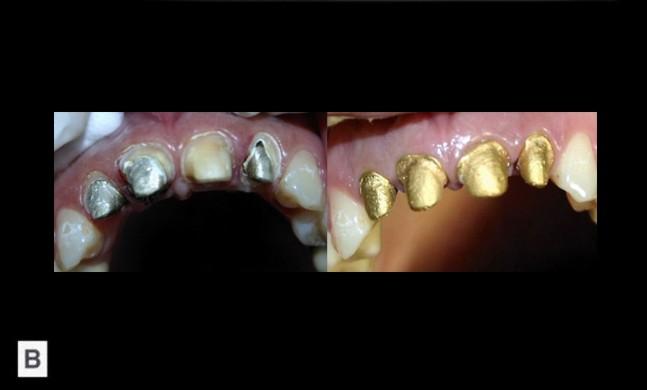 Discromii dentare şi dizarmonii de formă, mărime şi poziţie a celor patru incisivi superiori.. Fig. 7.23.B.