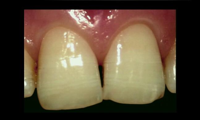 42 FIZIOLOGIA ŞI PATOLOGIA CROMATICII DENTARE Caracterizările se referă la două dintre cele mai comune aspecte ale efectelor optice: petele şi fisurile smalţului, precum şi la caracteristicile