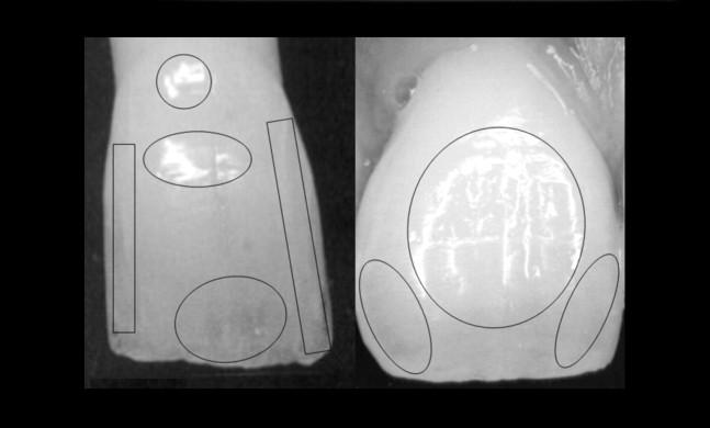 44 FIZIOLOGIA ŞI PATOLOGIA CROMATICII DENTARE Fig. 5.8.Percepţia estetică a cromaticii dentare: dinte vârstnic (stg.), dinte tânăr (dr.). Figura 5.9.