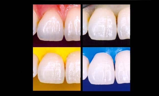 50 FIZIOLOGIA ŞI PATOLOGIA CROMATICII DENTARE Fig. 6.4.
