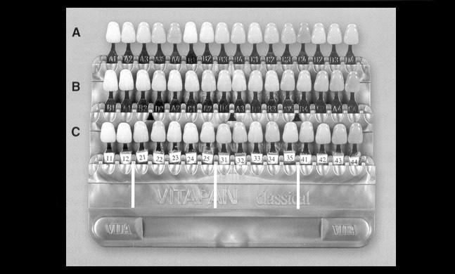 Cap. 6. Colorimetria în medicina dentară 51 culoare albastră (deoarece albastru şi galben sunt culori complementare 21.