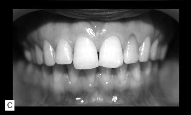 72 FIZIOLOGIA ŞI PATOLOGIA CROMATICII DENTARE Fig. 6.20.