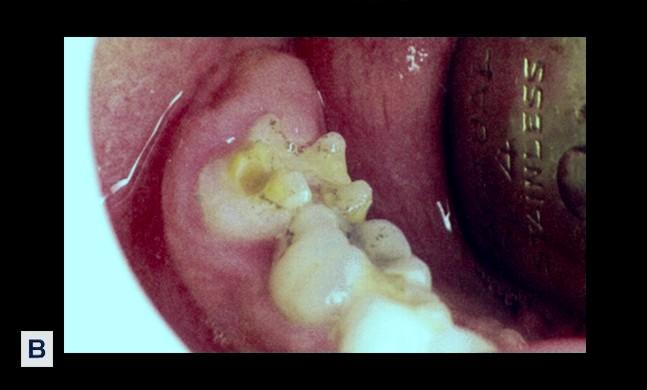 78 FIZIOLOGIA ŞI PATOLOGIA CROMATICII DENTARE Fig. 7.2.B.