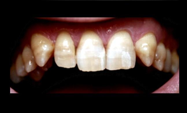 80 FIZIOLOGIA ŞI PATOLOGIA CROMATICII DENTARE de fluor, îşi încetinesc secreţia şi, astfel, se formează un smalţ hipomineralizat poros.
