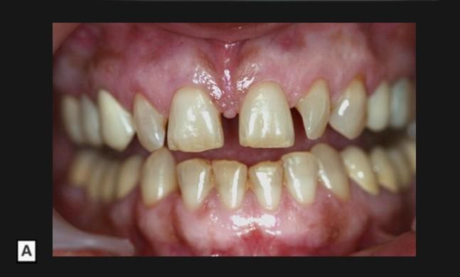 82 FIZIOLOGIA ŞI PATOLOGIA CROMATICII DENTARE Fig. 7.6.