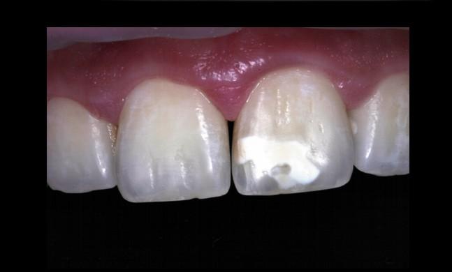 Cap. 7. Patologia cromaticii dentare 83 Minocyclovir, utilizat în tratamentul acneei.