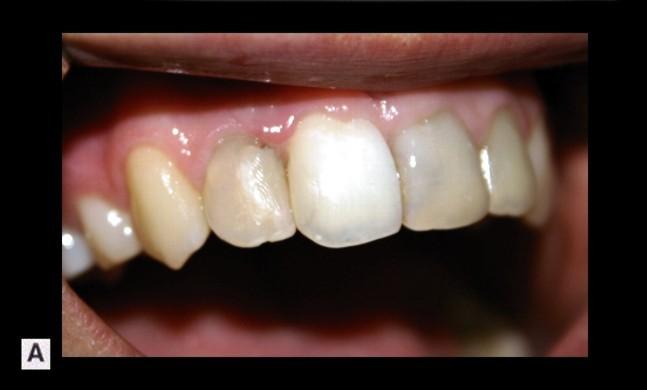 84 FIZIOLOGIA ŞI PATOLOGIA CROMATICII DENTARE modificări de structură ale ţesutului adamantin (linii, gropiţe), cât şi în alterări ale cromaticii coronare a acestor dinţi, care prezintă o culoare