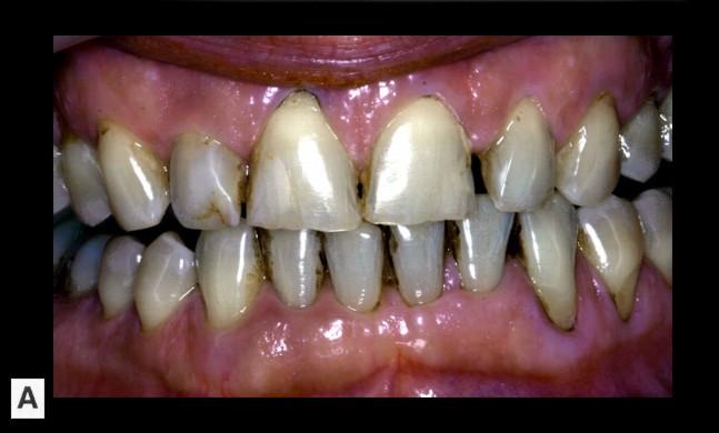 88 FIZIOLOGIA ŞI PATOLOGIA CROMATICII DENTARE Discromia la clorhexidină Clorhexidina a constituit de-a lungul timpului un interes deosebit în ceea ce priveşte mecanismul de colorare al dinţilor;