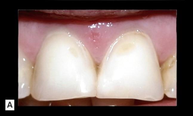 90 FIZIOLOGIA ŞI PATOLOGIA CROMATICII DENTARE Recesiile gingivele În zonele cervicale, unde smalţul este mai subţire, leziunilor de uzură dentară li se pot adăuga recesiile gingivale, accentuând şi