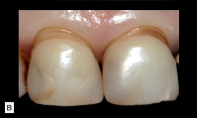 Atât uzura dentară cât şi recesiile gingivale sunt leziuni cu etiologie multifactorială încă incomplet elucidată. Fig. 7.11.A. Discromii dentare consecutive leziunilor de uzură dentară: ariile