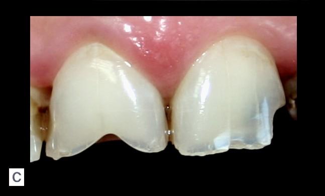 Cap. 7. Patologia cromaticii dentare 91 apă şi 1.0 pentru aer.