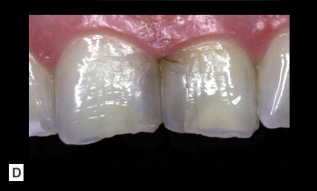 leziunii white spot lesion şi poate fi explicat prin modificarea procesului de transmitere al luminii 33.