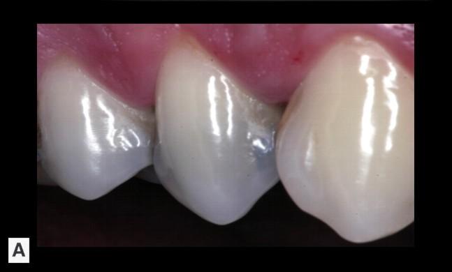 92 FIZIOLOGIA ŞI PATOLOGIA CROMATICII DENTARE Discromia cauzată de materialele utilizate în tratamentele dentare materiale de restaurare coronară Potenţialul cromogen al amalgamului determină