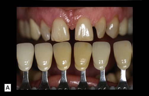 100 FIZIOLOGIA ŞI PATOLOGIA CROMATICII DENTARE Fig. 7.18.A. Discromie tetraciclinică (gradul II) la o pacientă de 49 de ani care prezintă lucrări protetice fixe în regiunile laterale ale maxilarului.