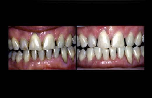 102 FIZIOLOGIA ŞI PATOLOGIA CROMATICII DENTARE reprezentând, fie o fază premergătoare tehnicilor de albire, fie o soluţie de temporizare a cestor tehnici, atunci când vârsta, prea tânără a
