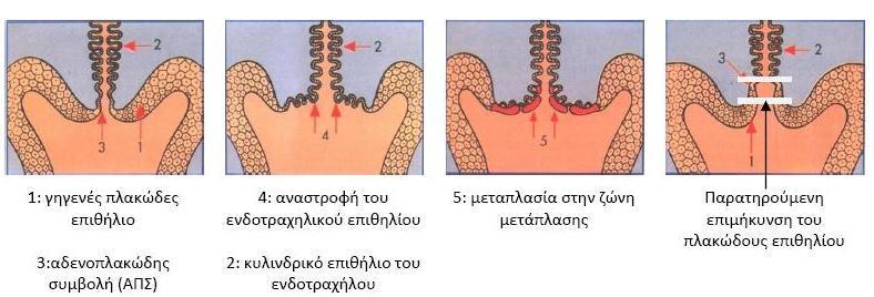 1.2.4 Μεταπλασία στον τράχηλο και παθοφυσιολογία 1.2.4.1 Αδενοπλακώδης συμβολή και ζώνη μετάπλασης Από τη γέννηση μέχρι την εφηβεία ο ενδοτράχηλος καλύπτεται από αδενικό κυλινδρικό επιθήλιο και ο εξωτράχηλος από γηγενές (γνήσιο) πλακώδες επιθήλιο.