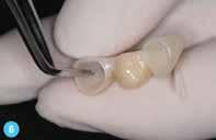Προθεραπεία των κολοβωμάτων (Γ): Απλώστε Tooth Primer, αφήστε το να δράσει για 20 δευτερόλεπτα, έπειτα στεγνώστε με φύσημα αέρα. 8.