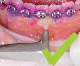 Ortho TRIBUNE The World s Orthodontic Newspaper Greek Edition EΛΛΑΔΑ, Ιουλιοσ - Αυγουστοσ 2018 Τομοσ 6, Τευχοσ 4 Ο ορθοδοντικός ασθενής Από την κόλαση στον παράδεισο T. Acret Η T.