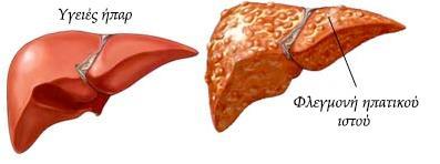 1.2.2 Ηπατίτιδα (Hepatitis) Ο όρος ηπατίτιδα σχετίζεται με τη φλεγμονή του ήπατος (Εικόνα 1.2). Τα γενεσιουργά αίτια αυτής είναι ποικίλα, με κυρίαρχα τους ιούς και τον αλκοολισμό.