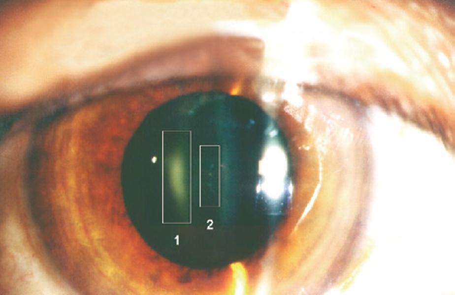 Εμφάνιση καθορισμένων (?!) αποτελεσμάτων Radio- induced crystalline lens opacity in an intervenhonal radiologist submi ed to high levels of radiahon using an X- ray tube above the table.