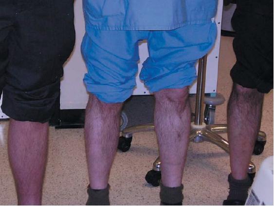Chronic occupahonal dermahhs inihally causes the skin to become dry, shiny and hairless, with atrophy of the epidermis. Vano et al.