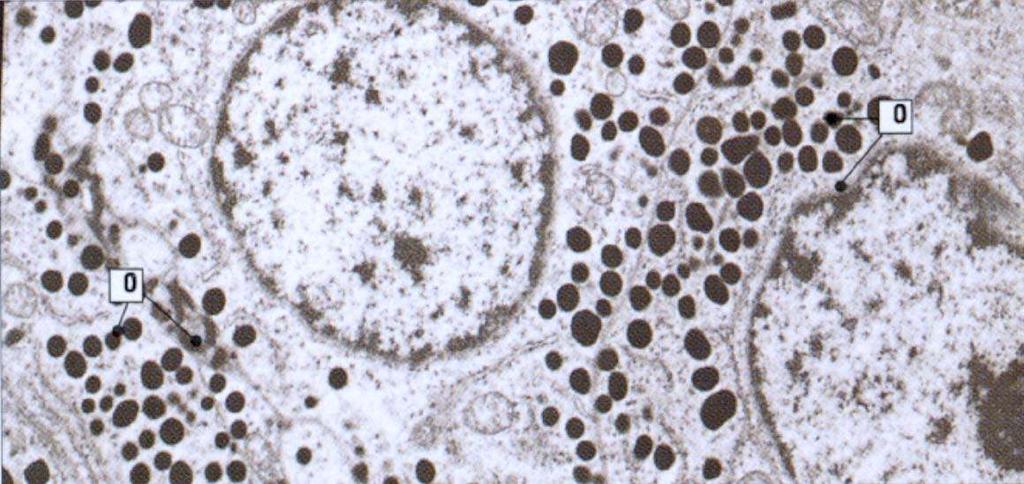 Ταυτοποίηση των κυττάρων της αδενοϋπόφυσης με το ηλεκτρονικό μικροσκόπιο: - ορμονο-εκκριτικά κύτταρα του πρόσθιου λοβού (πολυάριθμα κοκκία με