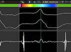 -177ms exit V6 Local EGM