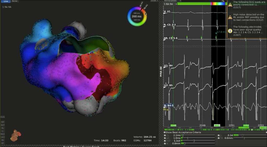 Typical atrial flutter