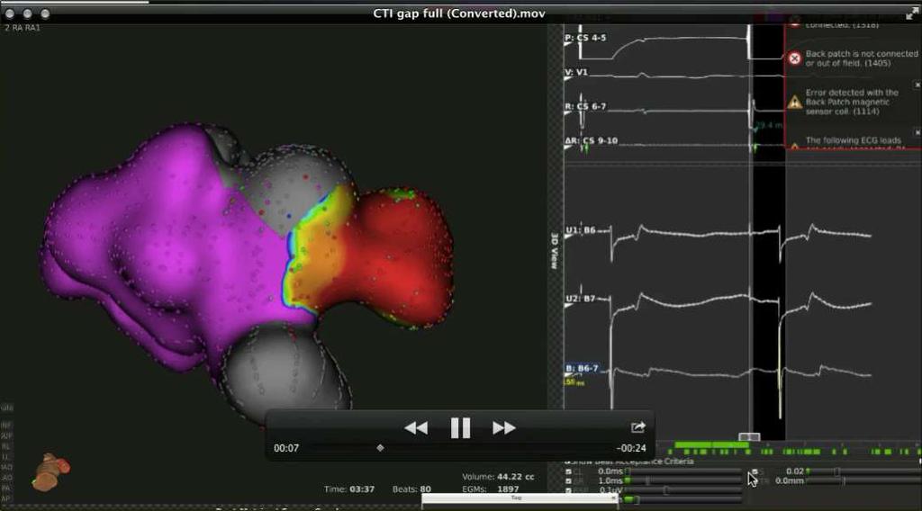 CS pacing