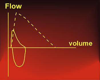 Typical changes of pulmonary function in interstitial lung disease FVC FEV 1 FEV 1 /FVC N FEF 25-75% N FEF 50 N