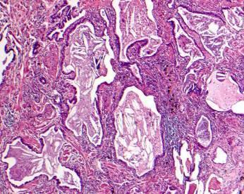 Ιδιοπαθής Πνευμονική Ίνωση Sarcoidosis Hypersensitivity pneumonia Pulmonary alveolar proteinosis Langerhan