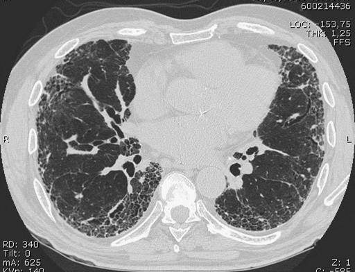 The diagnosis of IPF requires: a)exclusion of other known causes of interstitial