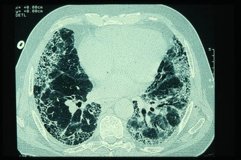 Idiopathic Pulmonary Fibrosis: Τυπικά χαρακτηριστικά στην αξονική τομογραφία υψηλής ευκρίνειας (HRCT)