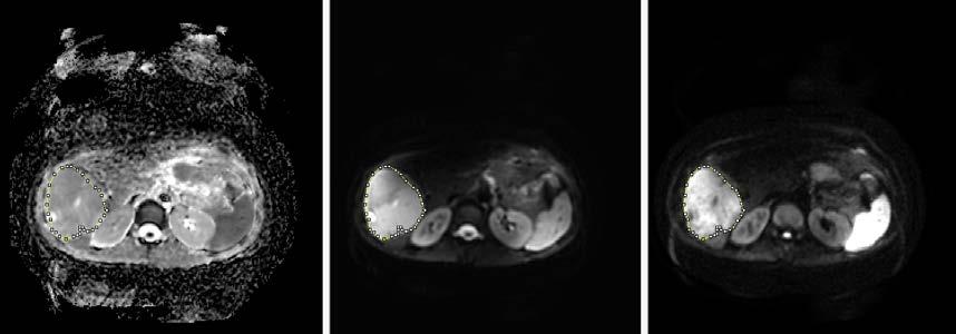 ADC Map b = 0 mm 2 /sec Image DWI (b=1000 mm 2 /sec) Ηλικία: 40