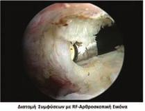 Η MRI με ή χωρίς σκιαγραφικό ή το MRI αρθρογράφημα, μπορεί να αναδείξει έμμεσα ευρήματα όπως η πάχυνση του αρθρικού θυλάκου και του κορακοβραχιόνιου συνδέσμου ή πάχυνση του θυλάκου της μασχαλιαίας