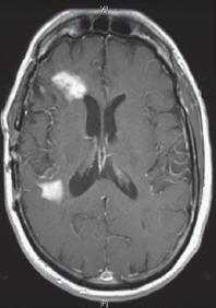 Ψευδοβελτίωςθ (pseudoresponse) μετά από κεραπεία με