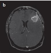Ψευδοεπιδείνωςθ (pseudoprogression) και ακτινικι νζκρωςθ Η κεραπεία του γλοιοβλαςτϊματοσ