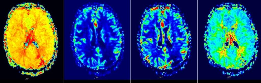 Ακολουκία αιμάτωςθσ (perfusion) Dynamic Susceptibility Contrast (DSC) - Η πιο αποδεκτι και καλφτερα μελετθμζνθ τεχνικι -Σεχνικι preload, με τθν βοικεια ειδικϊν μακθματικϊν αλγορίκμων (deconvolution