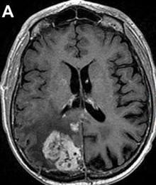 MR perfusion