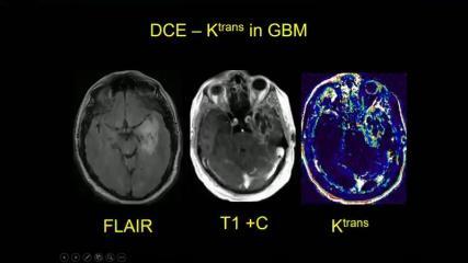 Ακολουκία αιμάτωςθσ (perfusion) Dynamic Contrast Enhance (DCE) - Χριςθ εικόνων T1 προςανατολιςμοφ για τθν αξιολόγθςθ