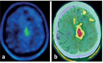 MRI 18F-DOPA PET/CT T2 υπόπυκνθ περιοχι T1 με ςκιαγραφικό χωρίσ