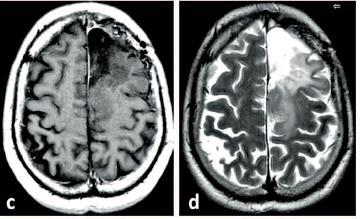 χειρουργθμζνου αςτροκυτϊματοσ Current status of 18F-DOPA PET imaging