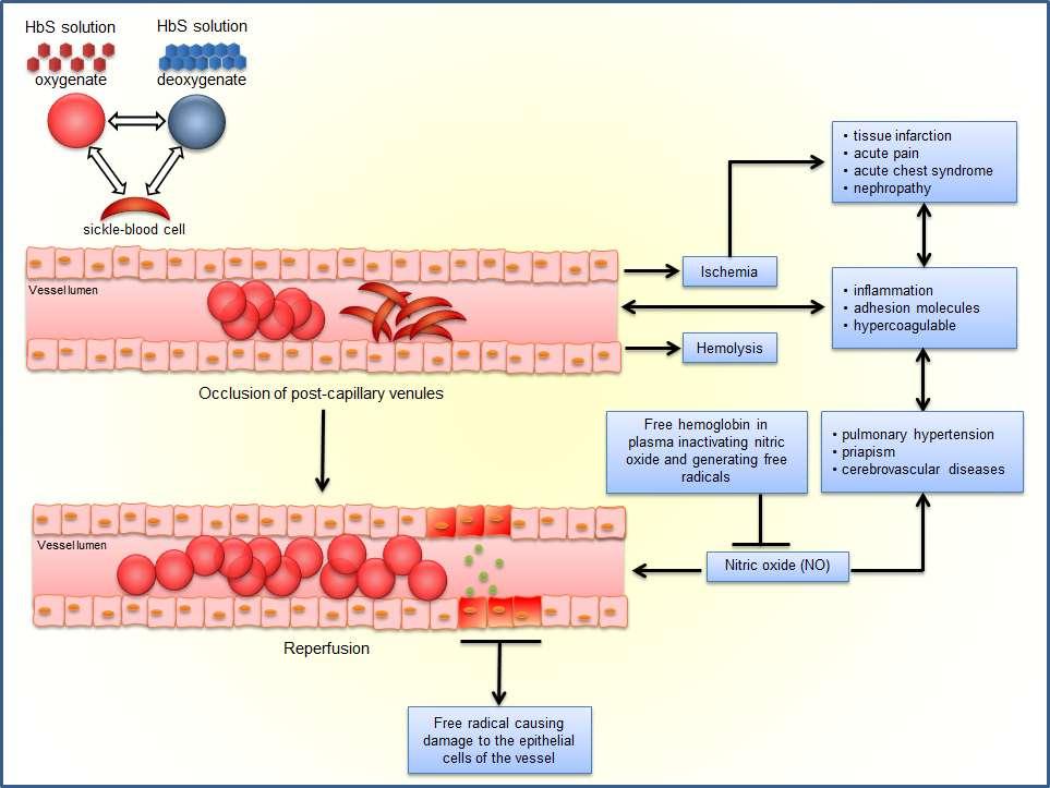 Sickle Cell Disease Current Treatment and New Therapeutical Approaches Anjana