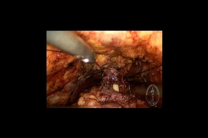 Anastomosis