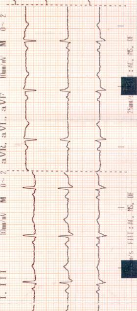 Increased duration, dispersion and variance of P wave duration are common in patients with