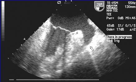 Left Atrial Appendage Is Potentially Thrombogenic «~90% of atrial