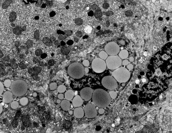 modificări de fenotip: miofibroblaste - colagenizările din spaţiul Disse - cresc