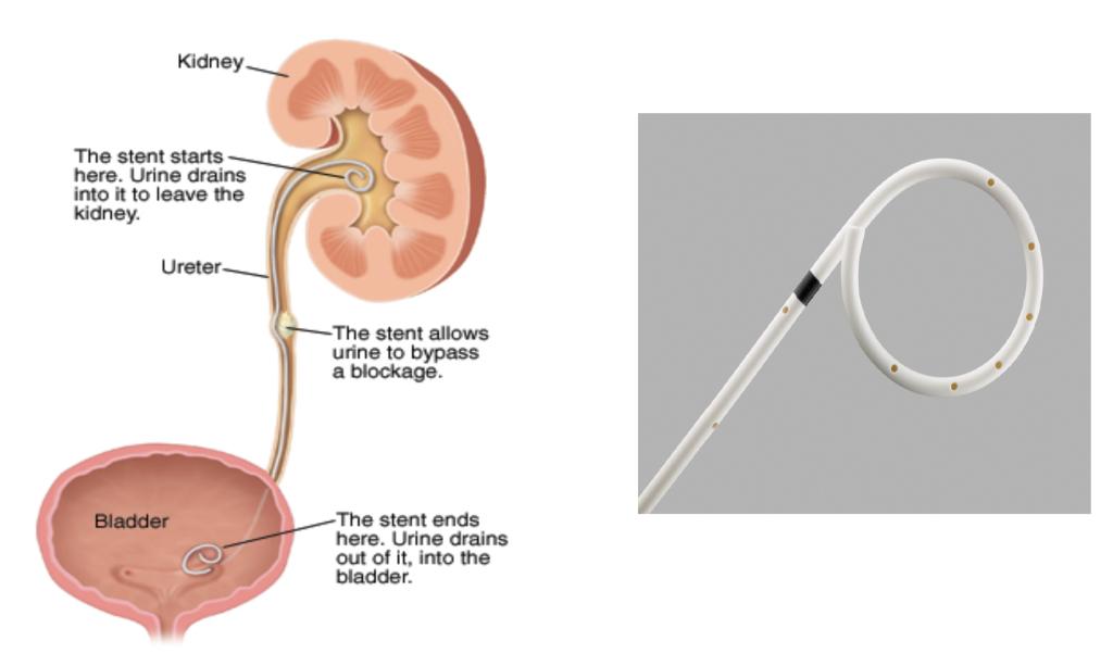 Stent ουρητήρα